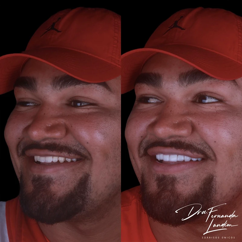 carrossel-facetas-em-resina-2