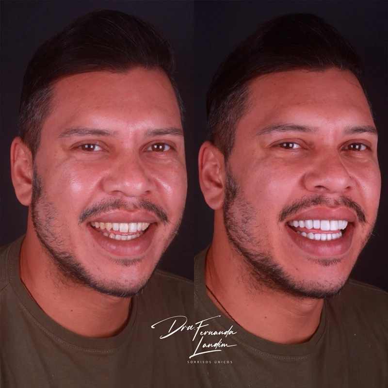 carrossel-facetas-em-resina-4