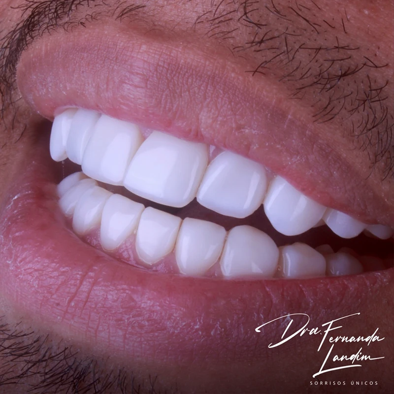 carrossel-facetas-em-resina-5