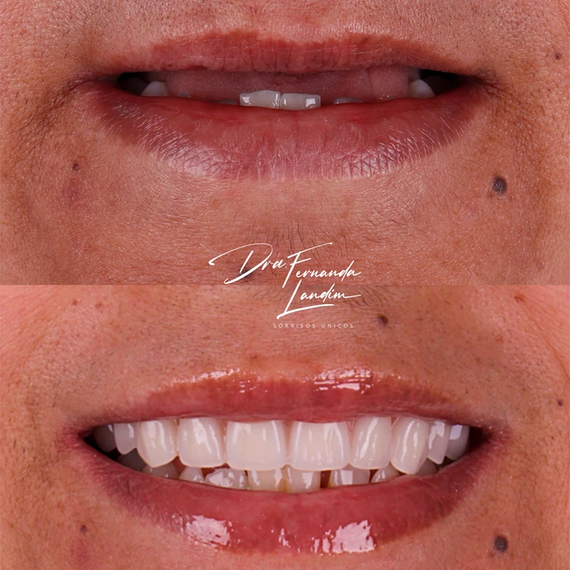 carrossel-implantes-dentarios-1