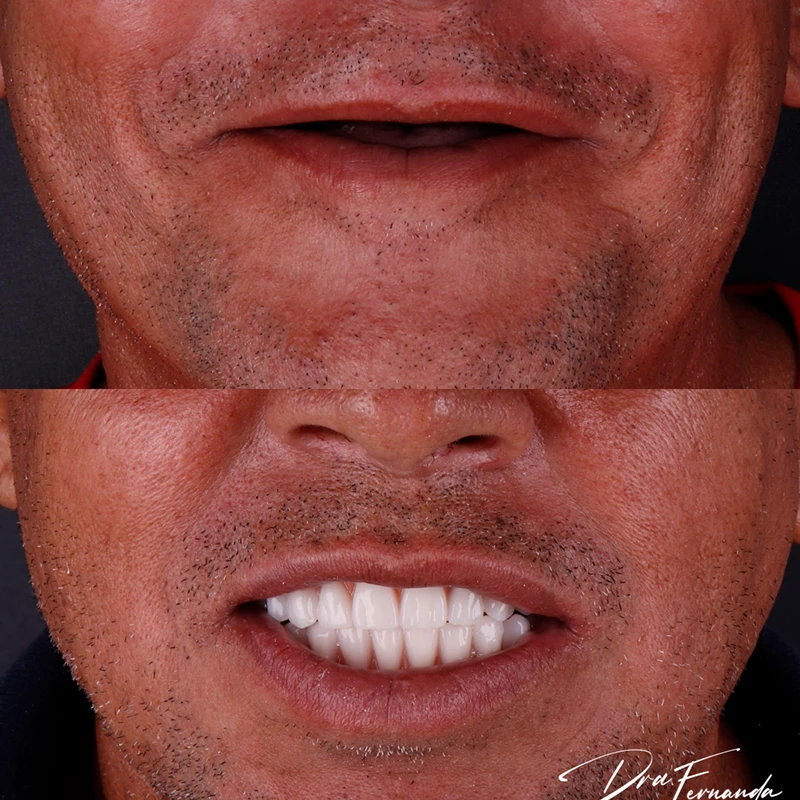 carrossel-implantes-dentarios-10