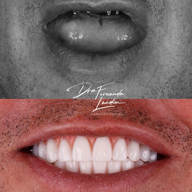 carrossel-implantes-dentarios-2