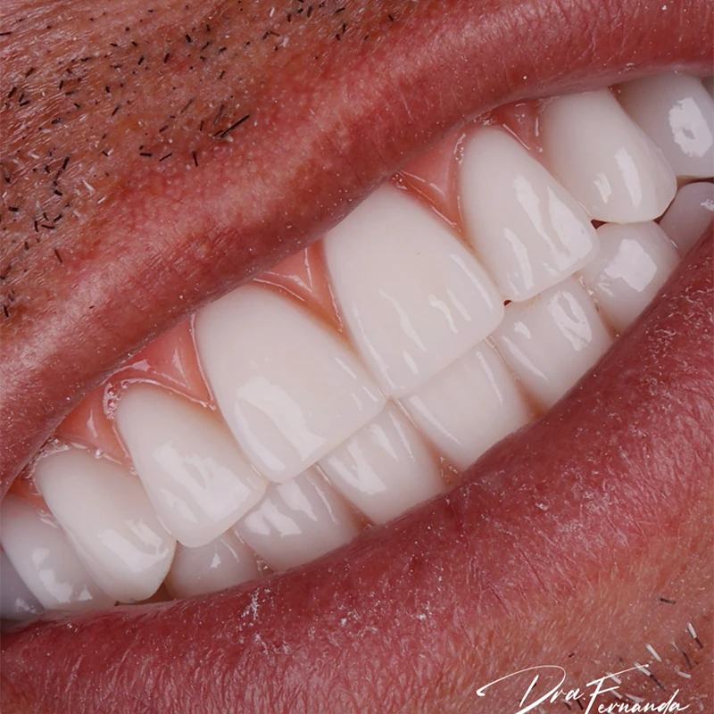 carrossel-implantes-dentarios-3