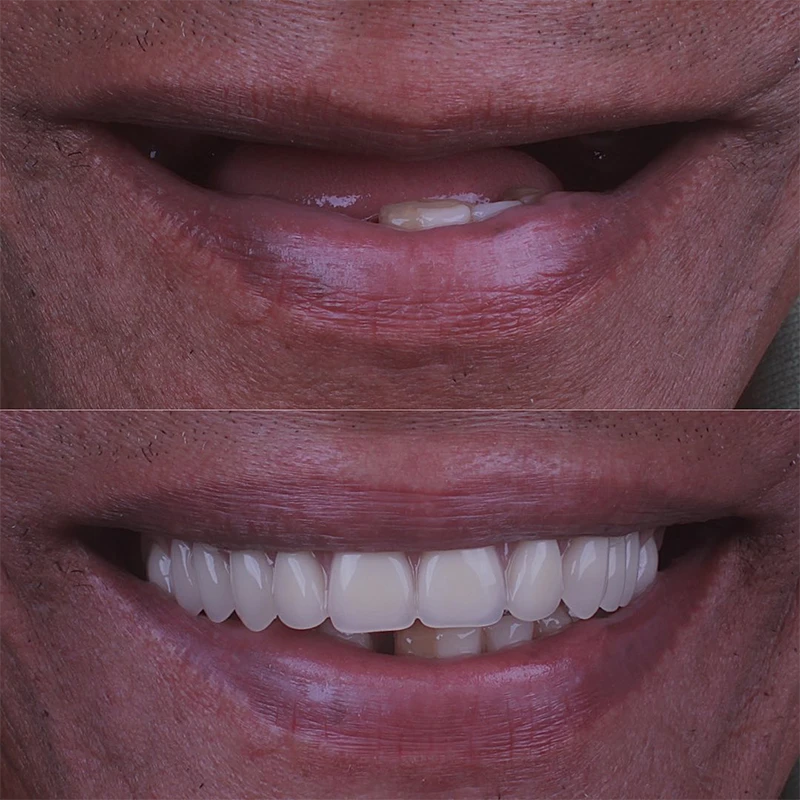 carrossel-implantes-dentarios-4