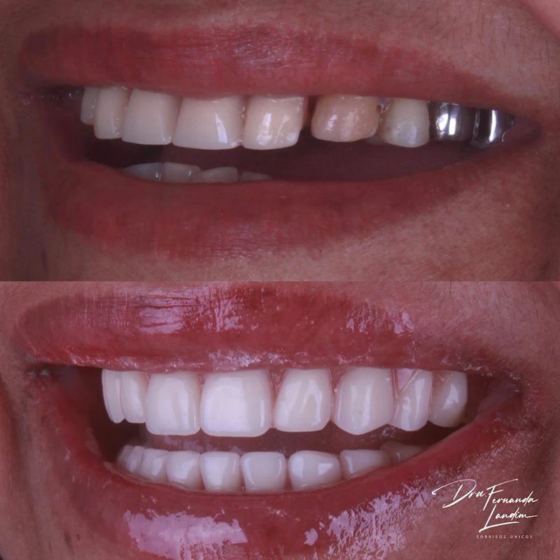 carrossel-implantes-dentarios-5