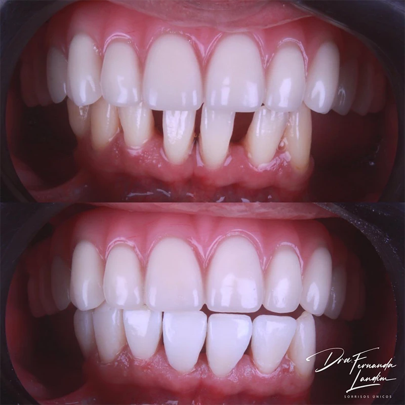 carrossel-implantes-dentarios-6