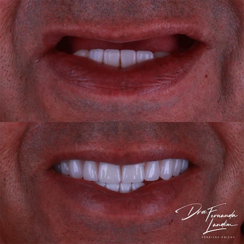 carrossel-implantes-dentarios-7