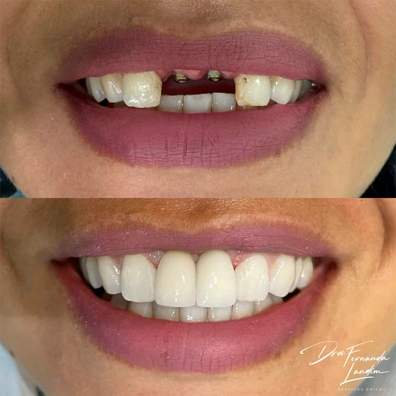 carrossel-implantes-dentarios-9